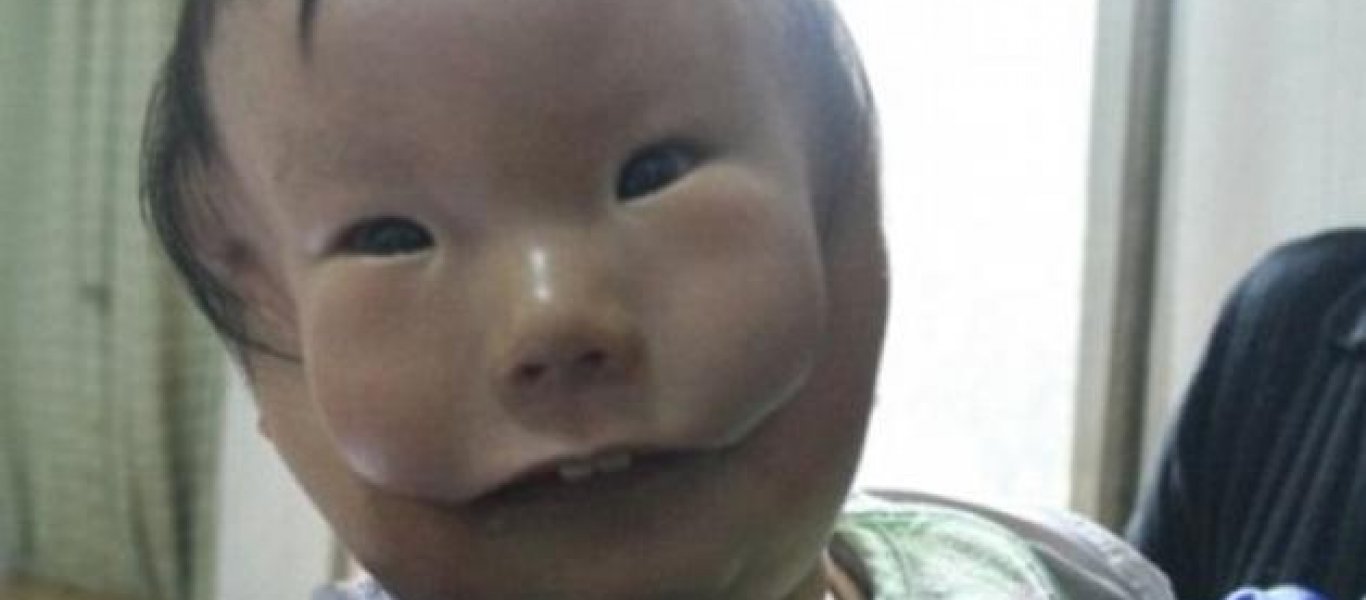 Κίνα: Το «παιδί-μάσκα» - Γενετική διαταραχή κάνει 8χρονο να έχει 2 πρόσωπα (φωτό)